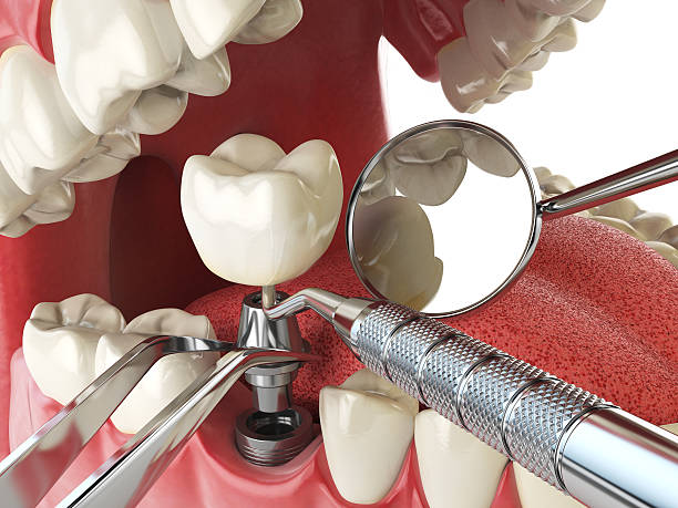 Best Emergency Dentist for Lost Fillings or Crowns in Pine Mountain Lake, CA